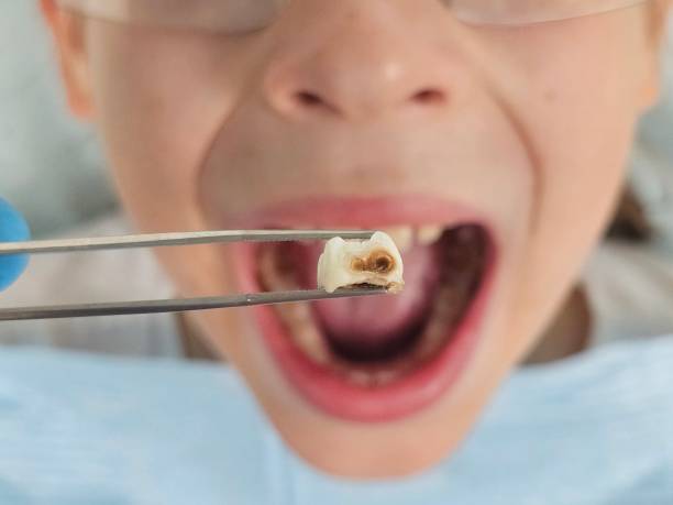 Best Broken or Cracked Tooth Emergency Dentist in Burlington, WA