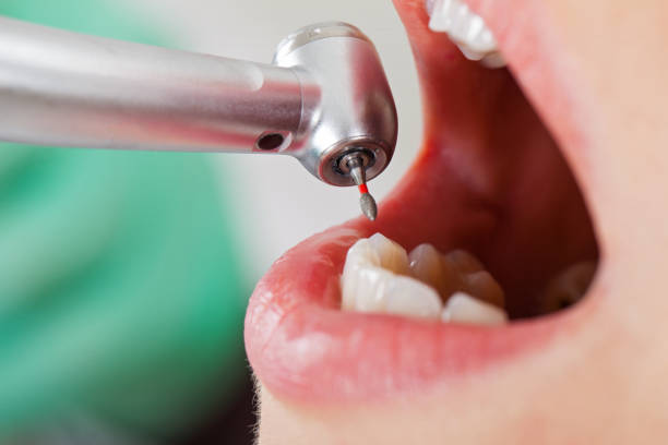 Best Emergency Dentist for Lost Fillings or Crowns in Burlington, WA